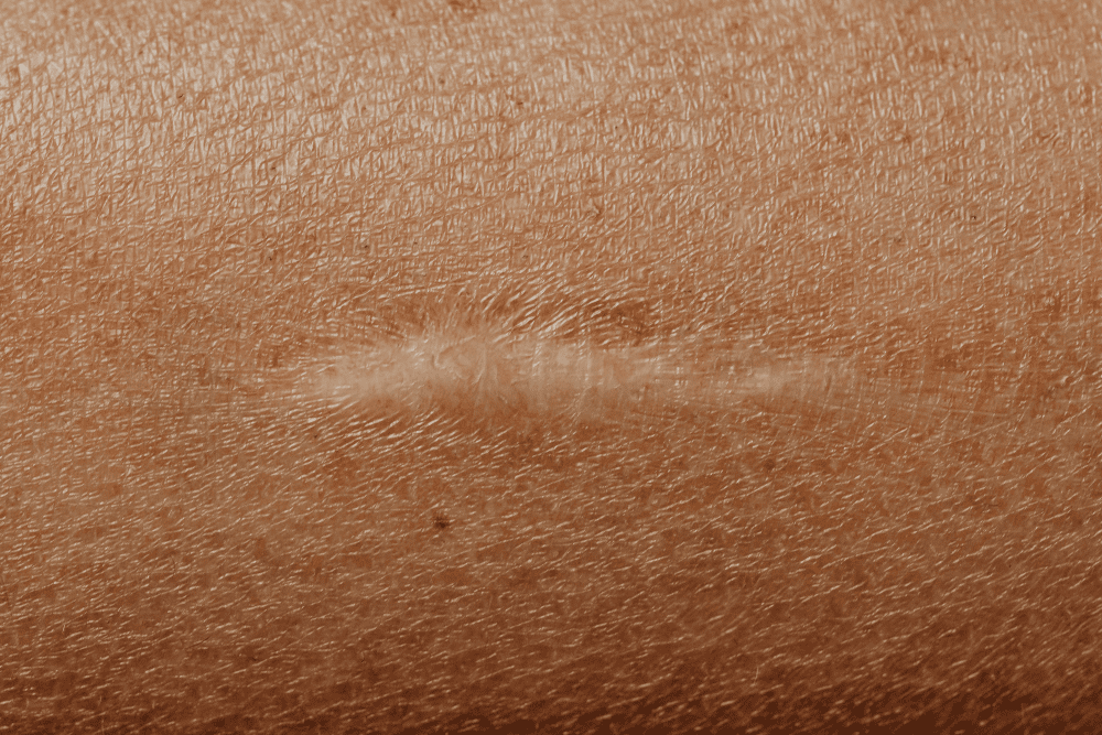 mohs scar